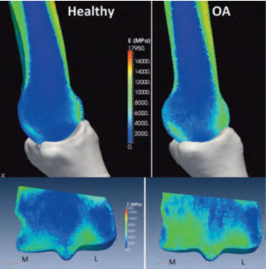 (image) Bone-density.--Healthy-and-Osteoarthritic